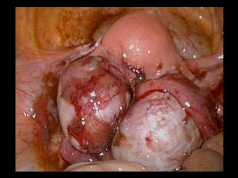 Endometriosis Right Left Ovarian Cysts Youssif Endometriosis Right Left Ovarian Cysts Youssif